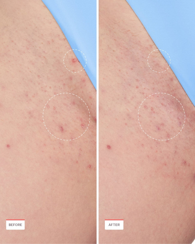 Ingrown Hair Roller