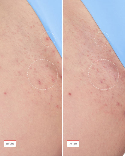 Ingrown Hair Roller